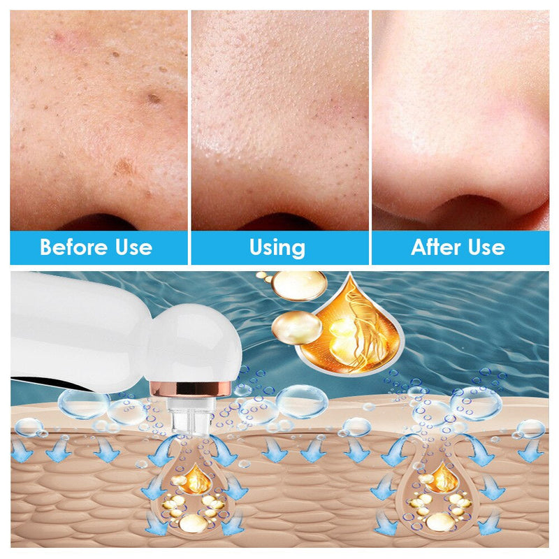 Mee-eter Remover and Hydrodermabrasion - HydraGlow