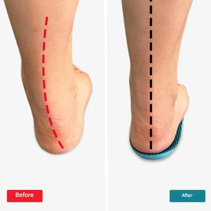 Orthopedic Insoles – StepRelief
