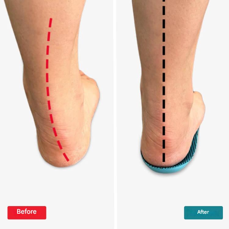 Orthopedic Insoles – StepRelief