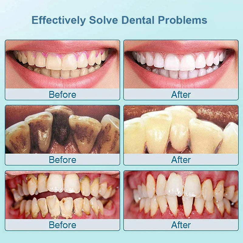 Ultrasone Tooth Cleaner - SonicClean