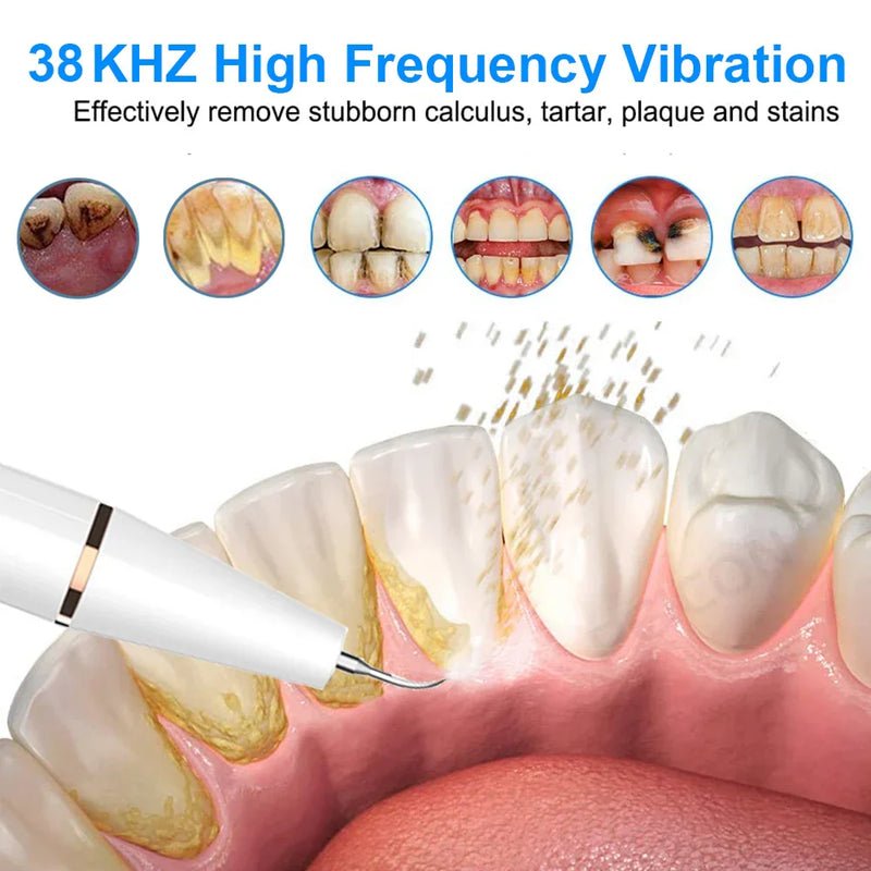Ultrasone Tooth Cleaner - SonicClean