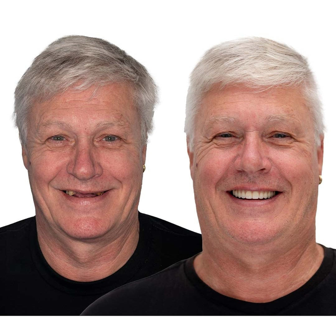 Vorher-nachher-Vergleich eines grauhaarigen Mannes in schwarzem Shirt: links mit lückenhaften Zähnen, rechts mit strahlend gleichmäßigem Lächeln. 5
