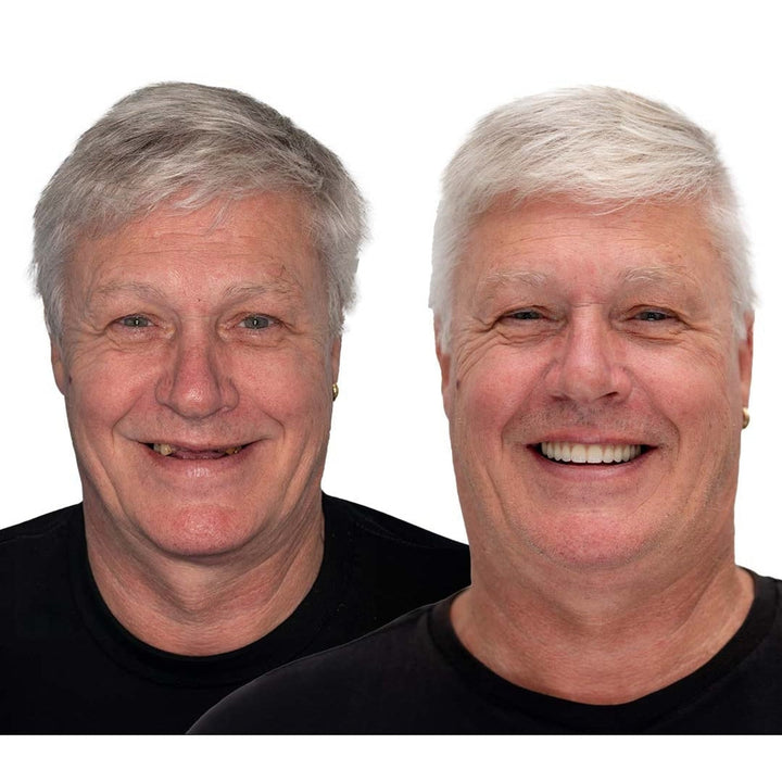 Vorher-nachher-Vergleich eines grauhaarigen Mannes in schwarzem Shirt: links mit lückenhaften Zähnen, rechts mit strahlend gleichmäßigem Lächeln. 5